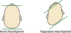 Infant with plagiocephaly illustration